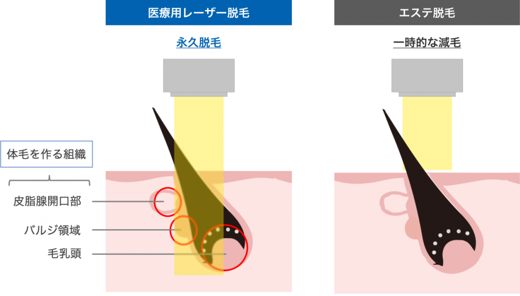 医療用脱毛とエステ脱毛の違い