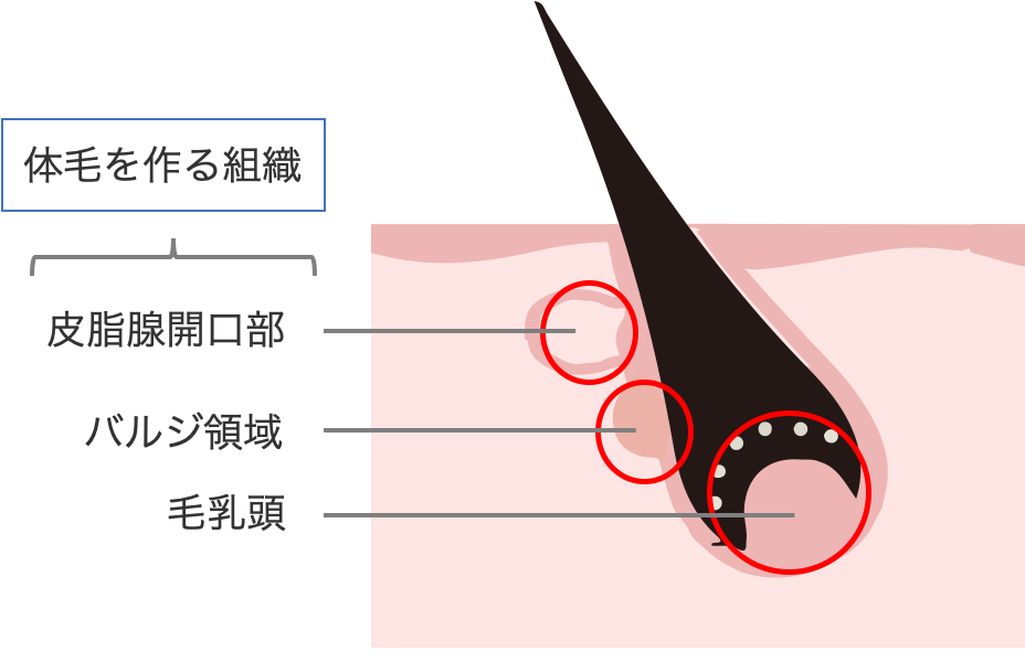 医療レーザー脱毛説明